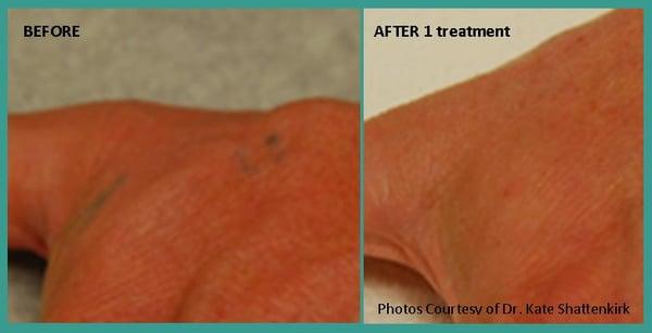 Hand Tattoo Removal after 1 Treatment