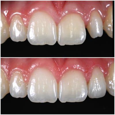 veneer restoration of a congenital small size lateral incisor