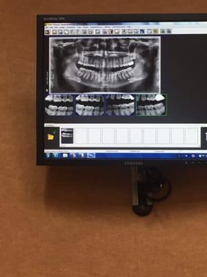 They keep a monitor above the chair so you can see your X rays. They also use a pen-size camera to show you any problem areas.