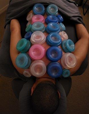 Cupping Therapy