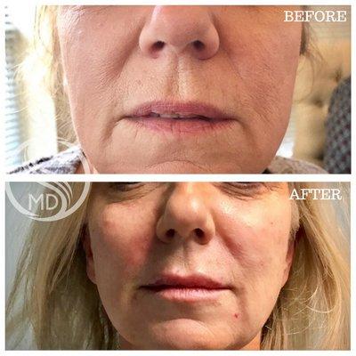 non-surgical facelift and lip filler