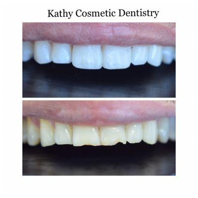 #bonding
 Restored chipped teeth and uneven smile with bonding (minimal invasive dentistry)