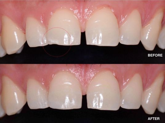 Before and After the filling of the chipped tooth