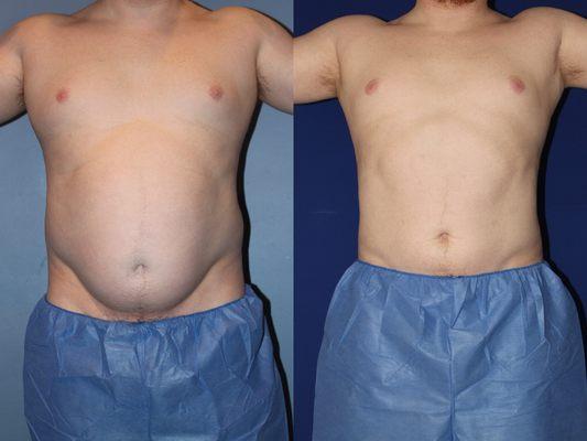 VASER Liposuction of the abdomen, waist and hips.