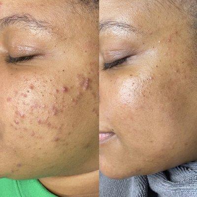 Before and after Green Peel and Microneedling series