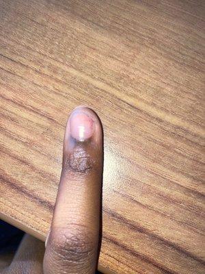 Still months later, after the nail popped of it left a uneven dent in my nail