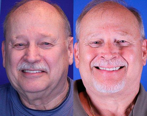 James Before & After Facelift in Nashville