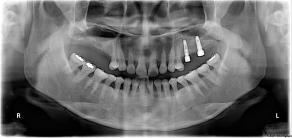 dental implants