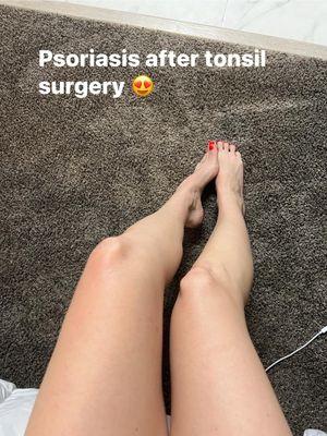 Psoriasis after tonsil surgery