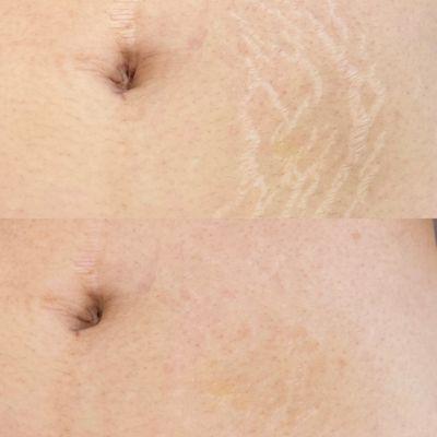 stretch mark revision