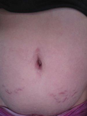 5 months post op tummy tuck. New stretch marks. Tried asking for advice and was told to just lose weight.