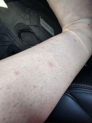 Some of the bites. They're all over in other places as well, but I'm in the car, so it's hard to capture all of them.