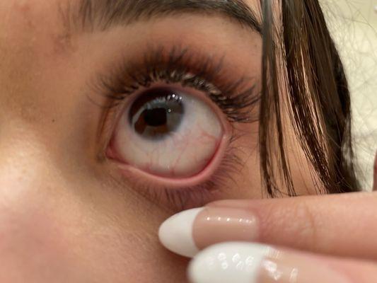 Chemical burn on left right eye