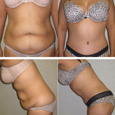 Tummy Tuck Before and After