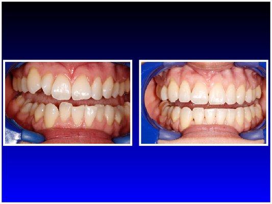 invisalign ... before and after