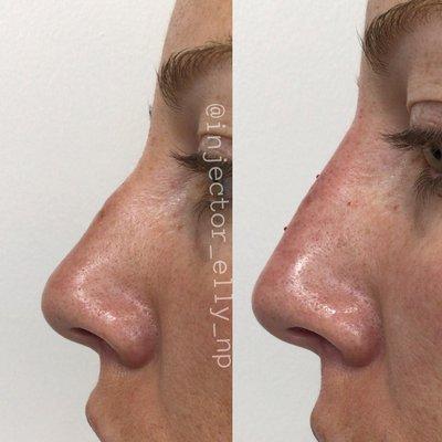 Nose Sculpting with Juvederm Vollure .