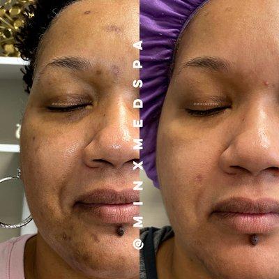 Hyperpigmentation Removal with 1 customized Microneedling Treatment.