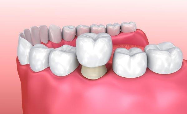 Dental Crowns North Las Vegas