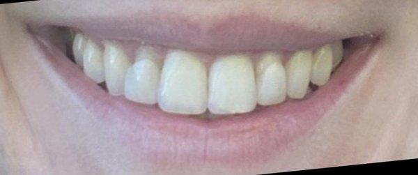 BEFORE: These were the improperly placed crowns that Dr. Pytlik fixed.