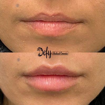 We're obsessed with this client's lip filler results....and so is she!