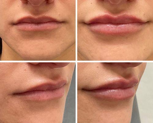 Minimal lip filler to enhance her natural shape without looking "fake" or too "done"