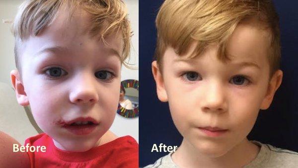 Very cute 3 year old boy with a lip laceration repaired by Dr. Chen in our office!  What a beautiful smile!