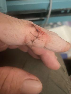 Pic of cut and stitches.