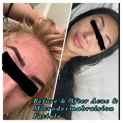 Before & After Acne & Microdermabraision Facials!