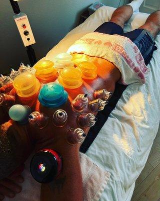 Cupping Therapy