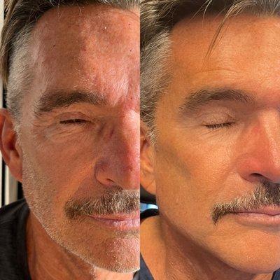 Radiesse Skin Rejuvenation