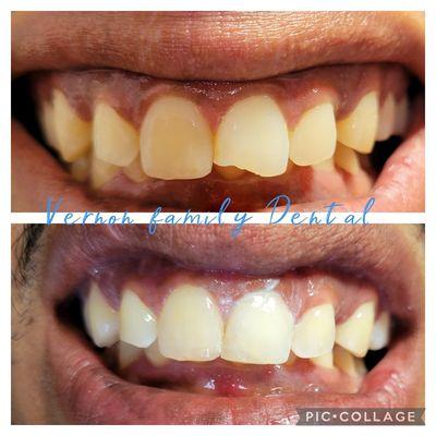 Bonding on a front tooth done in one appointment.