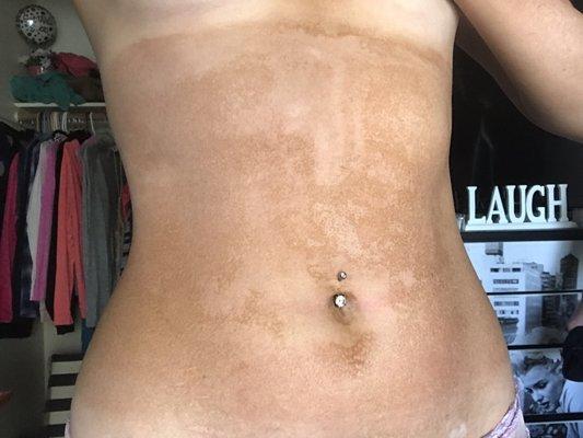 This is 6 hrs after a spray tan. This looks like vitiligo and they wouldn't even give me a refund.