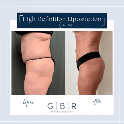 Liposuction in Virginia beach