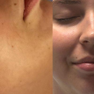 Before and after            60 minute facial