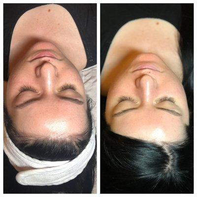 Before and After Organic Microdermabrasion