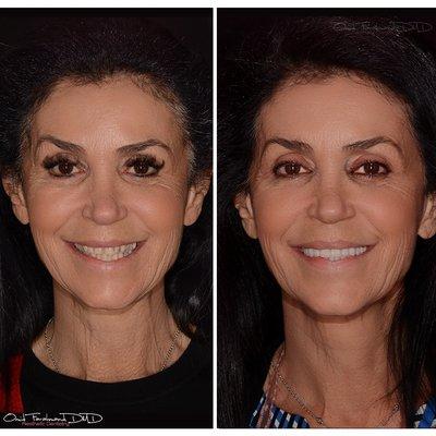 Porcelain veneers to bring this patient's smile back to life!