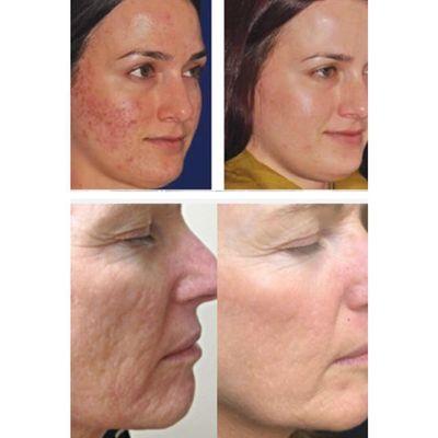 Microneedling... forget the pain and plastic surgeon. Microneedling is what you need!