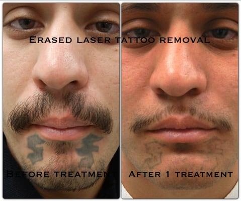 After the 1st treatment. Erased Tattoo Removal Las Vegas www.erasedlasertattooremoval.com