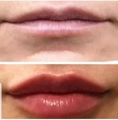 Lips augmentation treatment