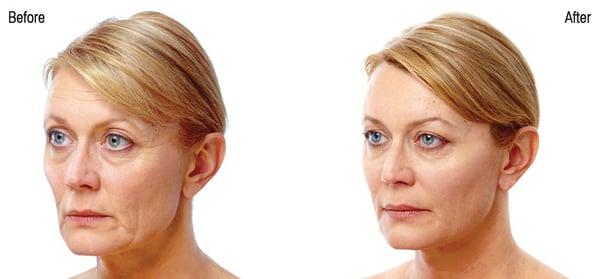 Voluma Dermal Filler