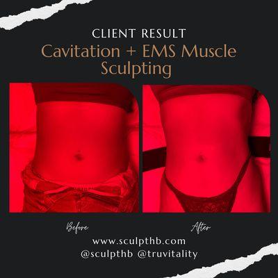 One session, cavitation, and EMS muscle sculpting