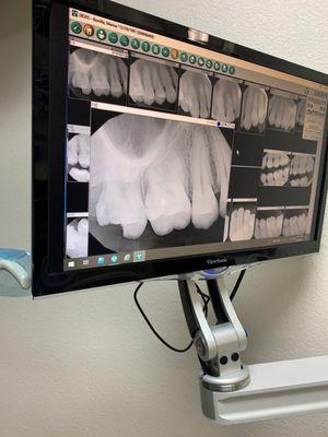 Filling of the tooth  broke off and it got infected. Dr.G, is one of the best, at what he does.