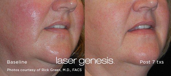 Laser Genesis for redness and pores