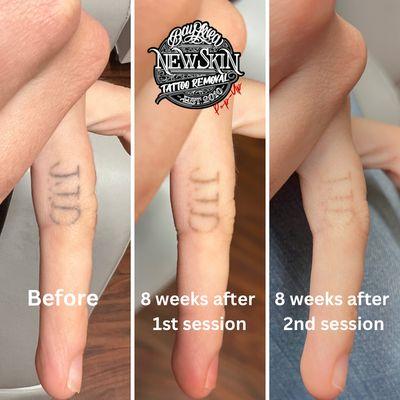 Finger tattoo removal