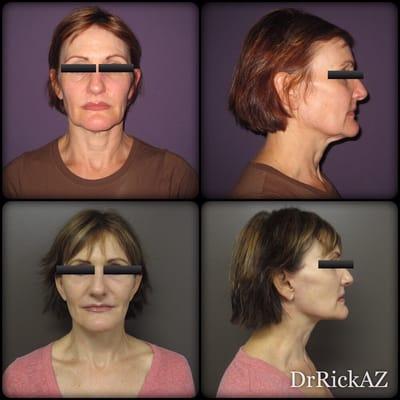 Facelift, Necklift, Lower Blepharoplasty with fat graft to lower eyelids only.