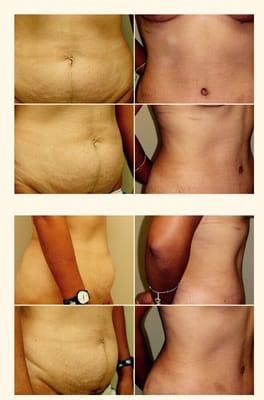 Before and after tummy tuck.