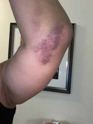 HUGE bruise from my fall at the store on 10/9/21