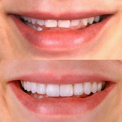 A beautiful transformation with natural looking veneers.