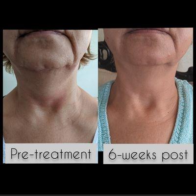 Neck lift