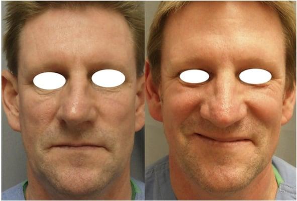 Septorhinoplasty for nasal breathing issues and a crooked nose